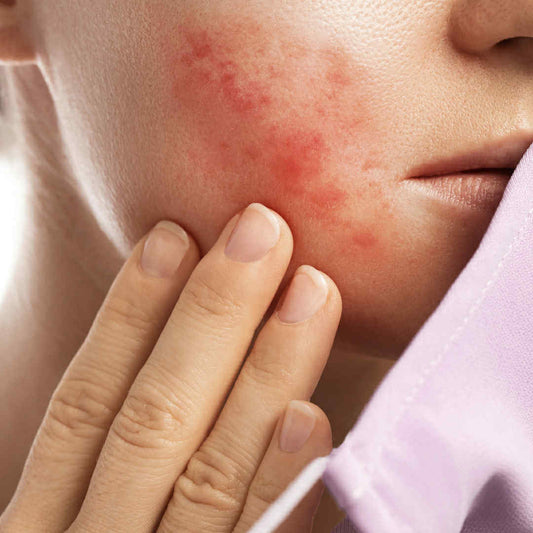 Acne Facial